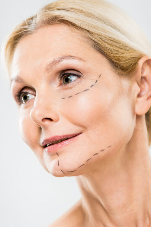 Foto volto donna con indicazioni per lipofilling
